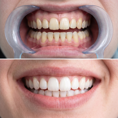 Purple Whitening Strips