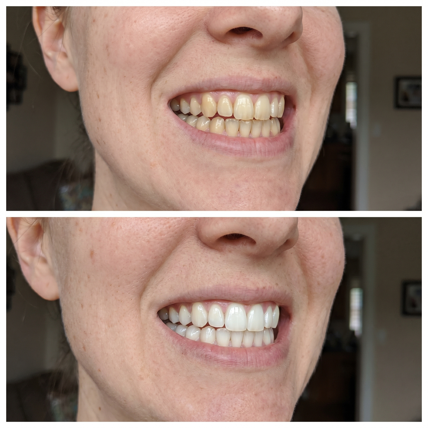Purple Whitening Strips