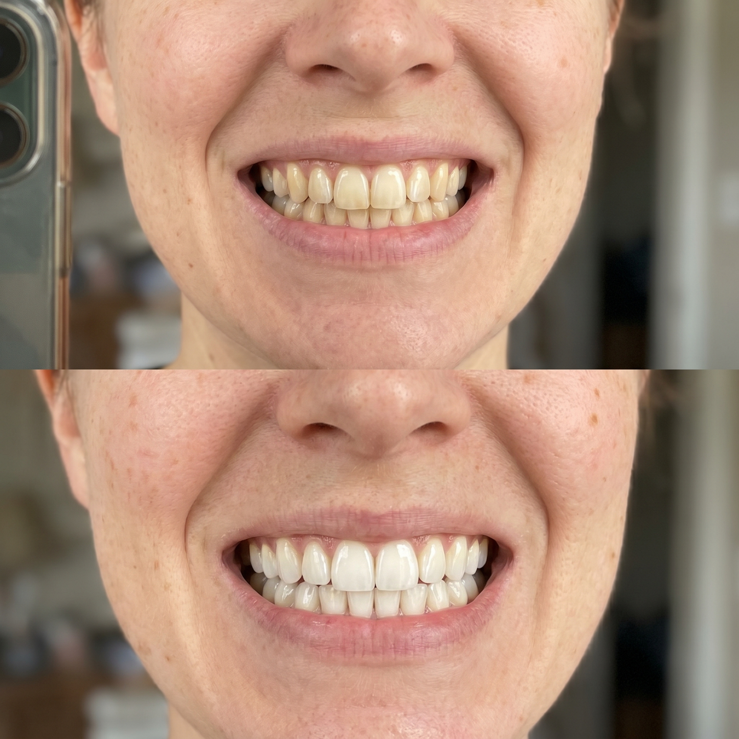 Purple Whitening Strips