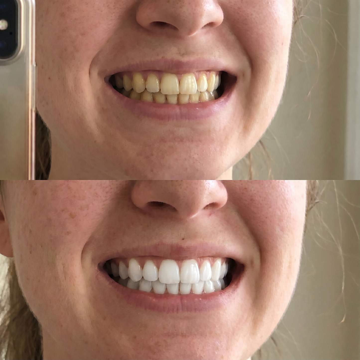 Purple Whitening Strips